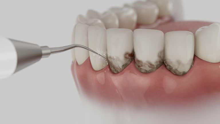 Trusted Dental Crowns And Bridges service in Powderly, TX - Dentist Open Now